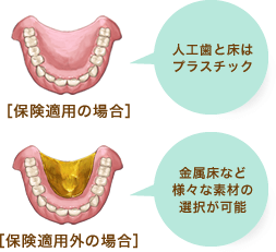 総入れ歯：保険適用の場合は人工歯と床はプラスチック