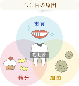 虫歯の原因は「歯質」「糖分」「細菌」です